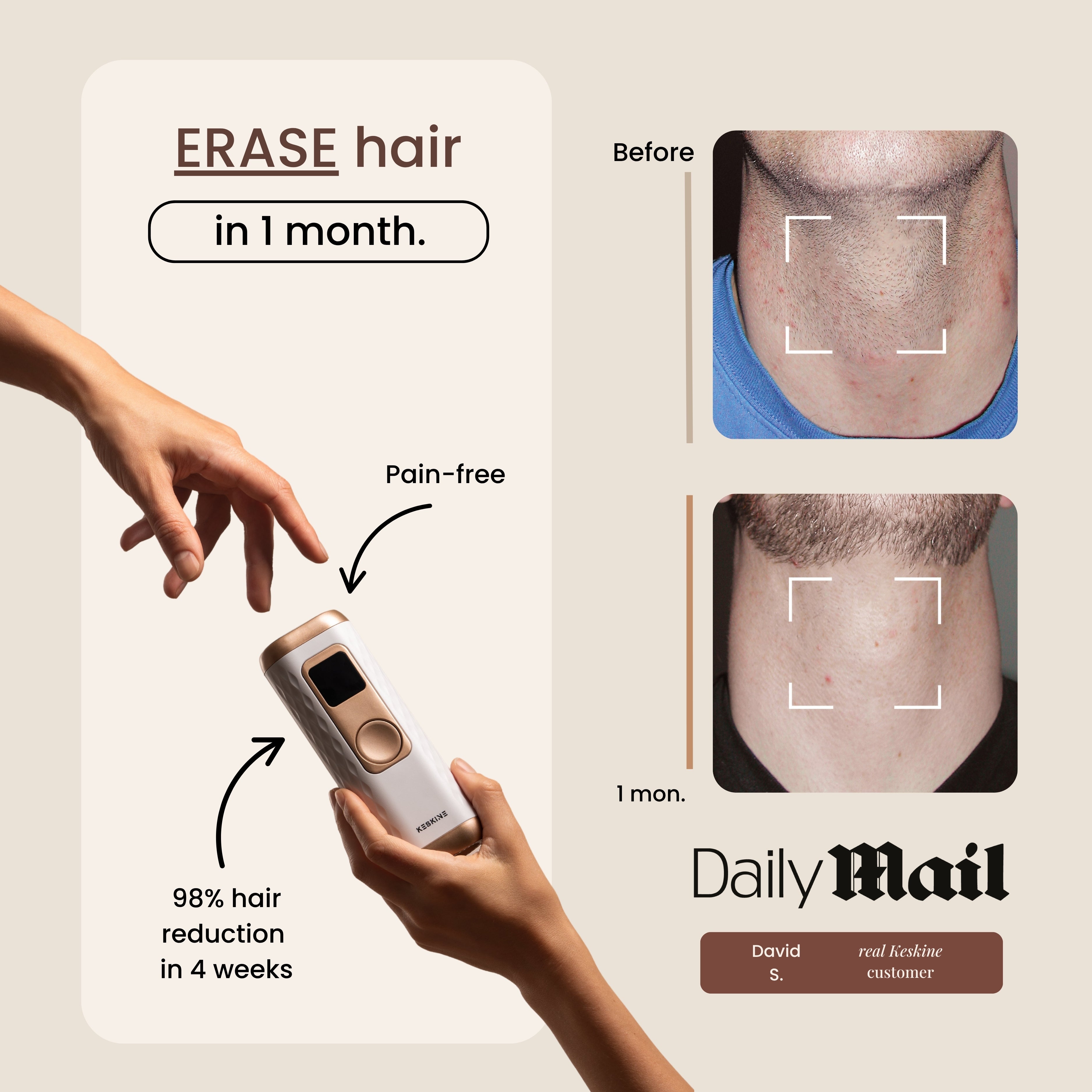 IPL Hair Removal Handset – Keskine